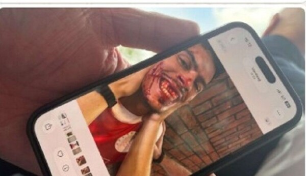 경악! "치아 7개 손상·유니폼은 피투성이"...경기 中 코치가 상대 선수 가격→"감독인 형까지 동반 퇴출"